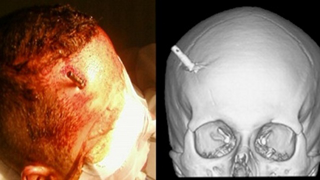 This Man Had a Taser Dart Stuck In His Brain and Didn't Even Realize